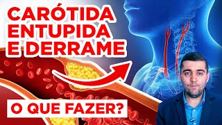 Carótida e AVC derrame como limpar atérias entupidas por coágulos de sangue e placas de gordura [upl. by Stelmach]