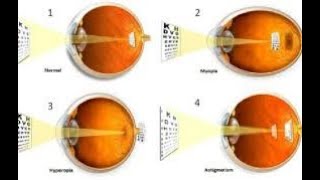 ERRORS OF REFRACTION [upl. by Ahsercel253]
