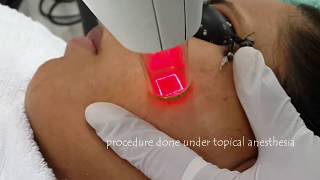 Laser treatment for acne scars  Fractional Non Ablative Laser  Dr Anuj Pall MD PhD FISD USA [upl. by Hukill]