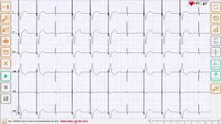 Tutorial CARDIOLINE TouchECG da CFS Prodotti Medicali [upl. by Coh]