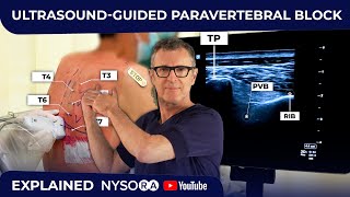 ULTRASOUNDGUIDED PARAVERTEBRAL BLOCK [upl. by Lucic]