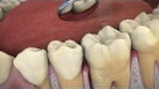 The Role of ARESTIN® in Periodontal Treatment [upl. by Torrey]