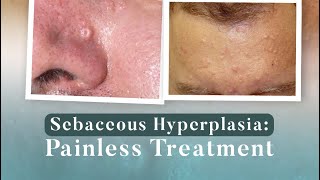 Sebaceous Hyperplasia Painless Treatment [upl. by Nole]