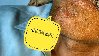 Warts on face  filiform warts removed [upl. by Noevart]