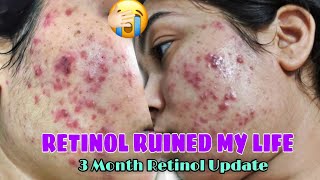 RETINOL SIDE EFFECTS MY 3 MONTH ACNE JOURNEY RETINOL BEFORE amp AFTERRETINOL JOURNEY [upl. by Ayikin]