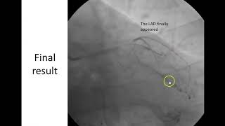 StentΛBalloon Technique for LAD ostial lesion 1 [upl. by Asirram384]