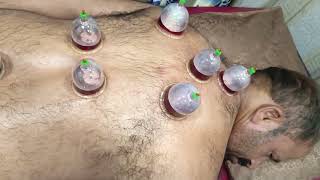 hijama therapy for pain relef and release toxic blood hashmi hijama and herbal [upl. by Ellerrehc]