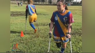 The beautiful amputee woman challenges the disability with one leg and crutches♥ [upl. by Ehtnax]