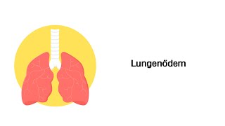 Lungenödem  Erkrankungen der Atemwege [upl. by Bethany]