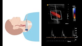 Scanning the extracranial arteries with ultrasound [upl. by Phedra746]