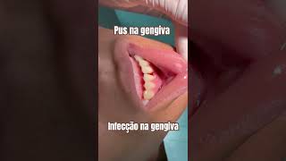 Infecção na gengivaosso 👉🏻 PERIODONTITE [upl. by Reilamag261]