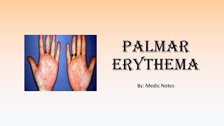 Palmar erythema causes and pathophysiology [upl. by Polloch]