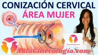 CONIZACIÓN CERVICAL QUÉ ES CUÁNDO y CÓMO SE REALIZA CONSEJOS  Ginecología y Obstetricica [upl. by Yerot]