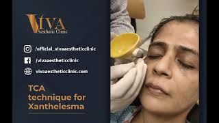 TCA technique for Xanthelasma  Dr Deepam Shah  Dermatologist in South Mumbai [upl. by Nnyleuqcaj]