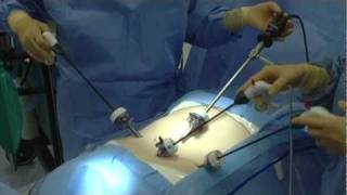 Laparascopic Hysterectomy Simulation Training [upl. by Harbot263]