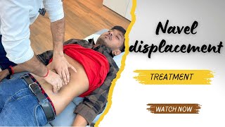 Navel displacement treatment in india [upl. by Omora]