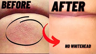 How To Remove Whiteheads And Blackheads From Chin At Home [upl. by Moran]