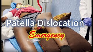 Patella Dislocation Emergency [upl. by Fidole682]