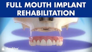 Full mouth rehabilitation with 6 dental implants and fixed denture © [upl. by Stag]