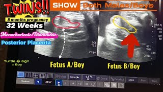 32 Weeks Twins  Boy  Boy  Both Male Fetus  Turtle 🐢 sign  Posterior Placenta  Ultrasound [upl. by Amora]