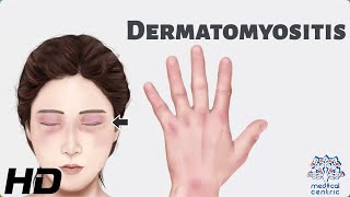 Dermatomyositis Everything You Need To Know [upl. by Ofilia]