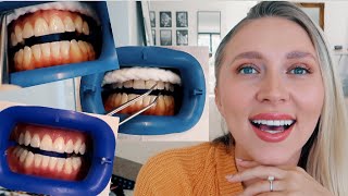 IS IT WORTH IT Professional teeth whitening BEFORE amp AFTER [upl. by Jezabella]