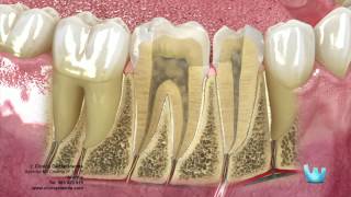 Endodoncia desvitalizar el nervio dental [upl. by Ginsberg]