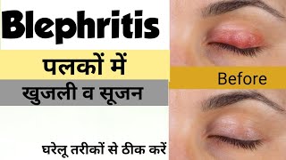 पलकों में खुजली व सूजन  घरेलू तरीकों से ठीक करें । shubhameyecare [upl. by Eelanej]