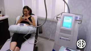 CoolSculpting to Lower Abdomen [upl. by Atikahs]