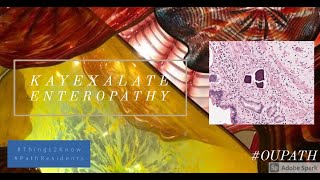 Kayexalate enteropathy [upl. by Adriana909]