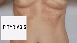 Pityriasis Causes Symptômes et diagnosticTraitements [upl. by Arretal]