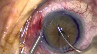 DMEK Hornhauttransplantation  Endotheltransplantation die wichtigsten Schritte OPVideo [upl. by Hamirak]