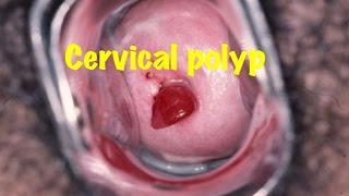 Medical Video Lecture Cervical Polyp OBGYN [upl. by Hallett843]