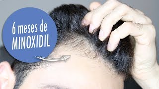 MINOXIDIL DEPOIS 6 MESES [upl. by Abbub]