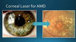 Laser Advanced Macular Degeneration Surgery Toronto  Bochner Eye [upl. by Patric]