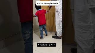 Ataxic Gait in Ataxia Telangiectasia ataxia telangiectasia cerebellar [upl. by Notxed]