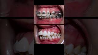 Crooked teeth amp overbite braces braces orthodontist dental [upl. by Enilra]