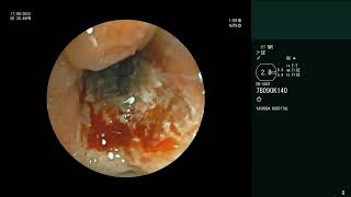 Pulmonary Mucormycosis  Bronchoscopy  Biopsy [upl. by Darian]