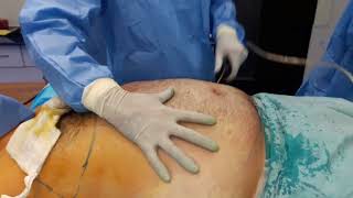 best liposuction lahore pakistan Dr Amin Yousaf [upl. by Ettegroeg714]