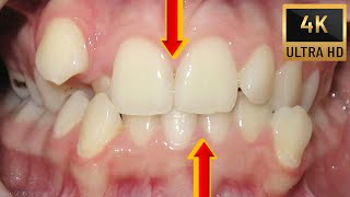 Extraction Of Lower Second Premolar [upl. by Sherwood568]