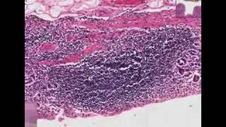 Histopathology StomachChronic gastritis [upl. by Kumler911]