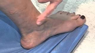 Varicose Vein Removal Procedure [upl. by Snej]