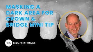 Masking a Dark Area for Crown amp Bridge  Clinical Mini Tip with Dr Dennis Hartlieb  DOT [upl. by Arlo751]