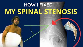 How I Reversed Spinal Stenosis without Surgery [upl. by Ronnica]