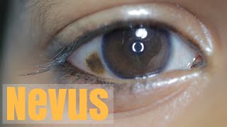 Conjunctival Nevus [upl. by Bald303]