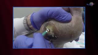 WCW Managing Diabetic Foot Ulcers  Debridement and Classifying Ulcers [upl. by Hnid]