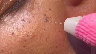 DPN Dermatosis Papulosa Nigra Removal [upl. by Rankin]