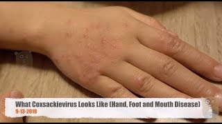 What Coxsackievirus Looks Like  Hand Foot and Mouth Disease [upl. by Nalliuq]