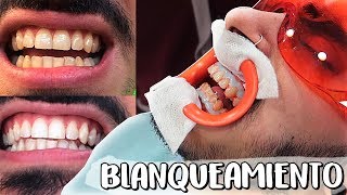 Mi EXPERIENCIA con el BLANQUEAMIENTO DENTAL funciona [upl. by Ruskin]