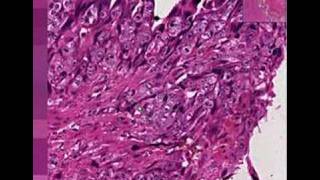 Histopathology UterusChoriocarcinoma [upl. by Aldon564]